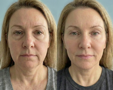 The inflammation is finally gone.